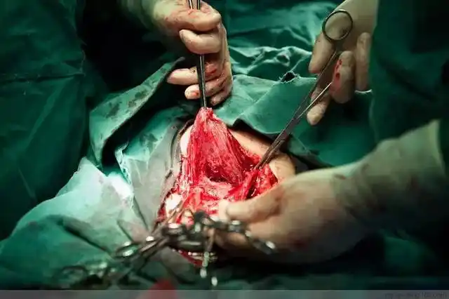 直击剖腹产过程现场触目惊心的100张照片