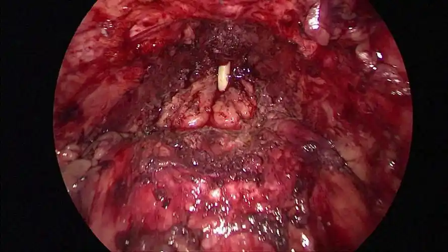 于2020年6月23日成功完成一例腹腔镜前列腺癌根治术,手术历时2小时