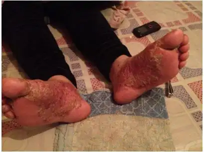 脓包疮的症状的照片 (1)_有来医生