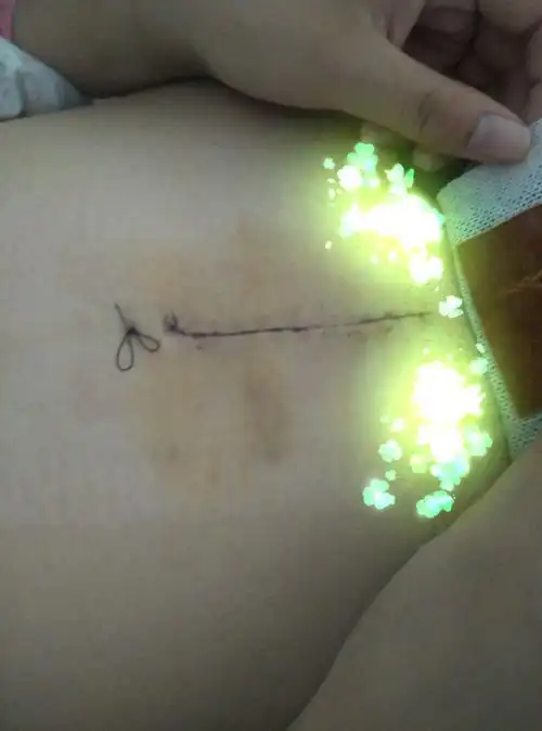 69 论坛 69 宫外孕 69 开腹手术后的疤痕越来越粗了,怎么办 20