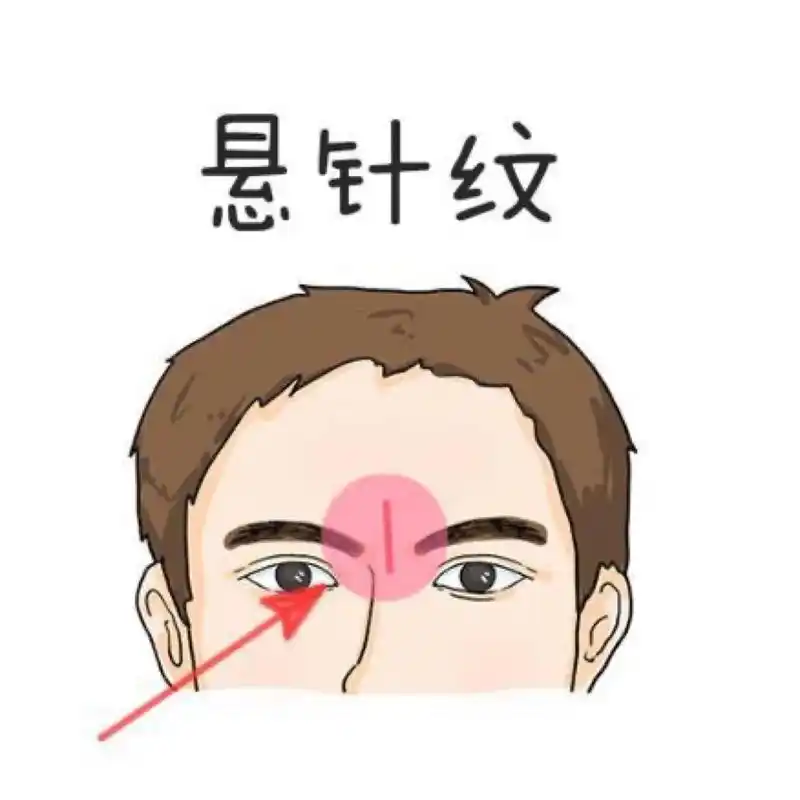 解析印堂有悬针纹好不好?