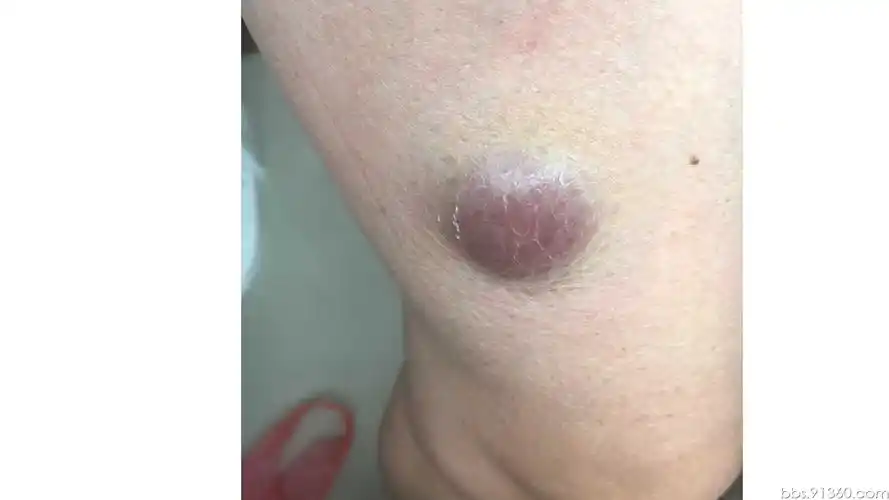 (右大腿)皮肤母细胞性浆细胞样树突细胞肿瘤【52086群第63题】