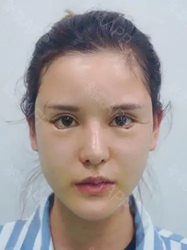 做了一个外眼角和下至,原本想做的夸张一点的,但是医生说我眼睛基础