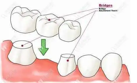 牙冠修复示意图