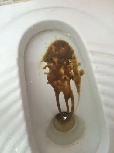 我女朋友生病了拉这样的屎 她不肯去医院 我很担心她 应该吃什么药