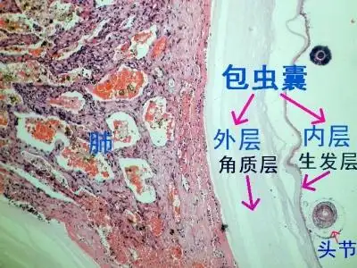 常见的虫子少见的部位3肺内包虫