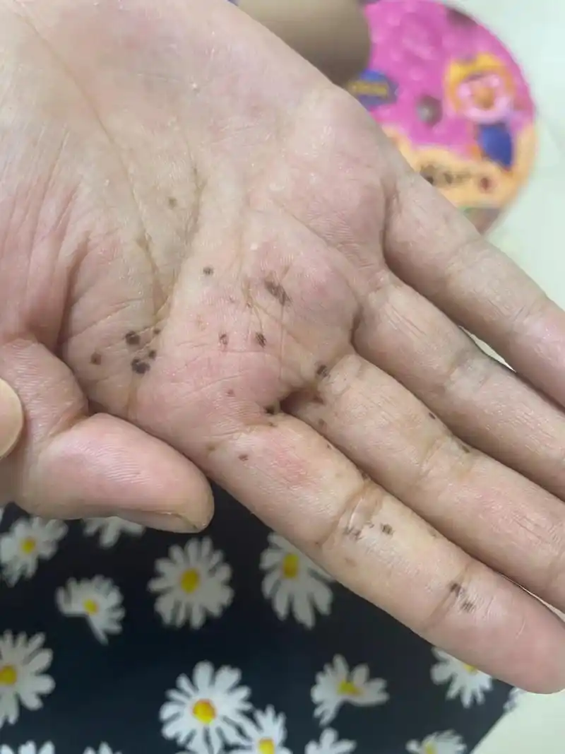 我闺蜜的儿子,今年9岁半,5岁的时候把手摔了,破皮后里面进去了脏东西