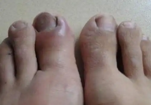 通常会在脚趾上表现,如果自己的脚趾出现了肿大呈杵状,也就是我们通常