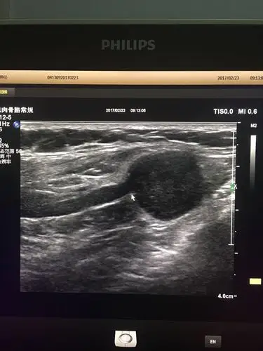 腓总神经神经纤维瘤可能,箭头指神经与病变延续处