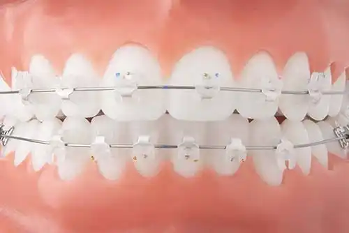 国产陶瓷半隐形矫正示意图