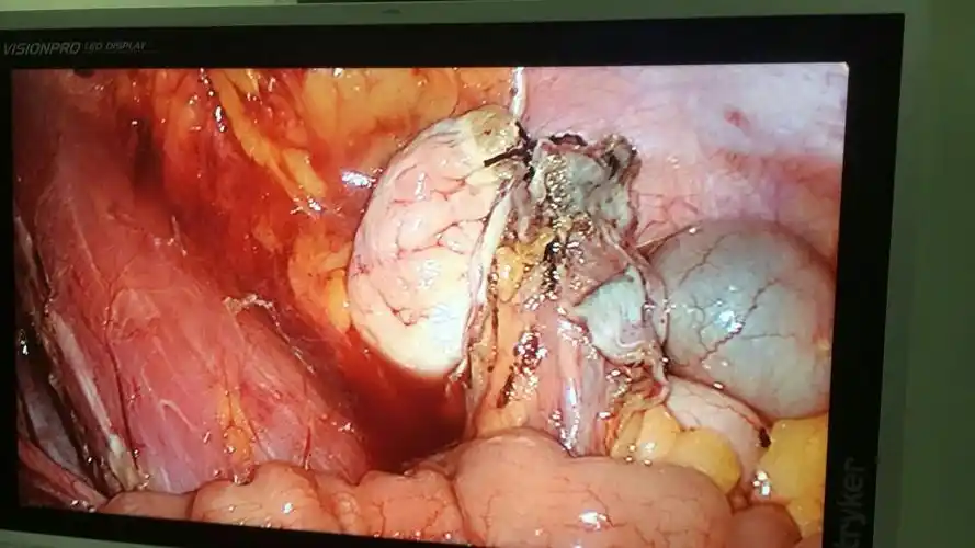 33岁宫颈癌患者,腹腔镜下广泛子宫切除 盆腔淋巴结清扫术 卵巢移位术