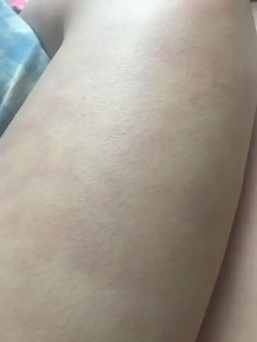 腿上会有紫色斑块.请问是怎么了,体检一切正常