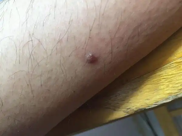 小腿上长了个和瘊子一样的东西,不知道是不是,如果是请问怎么处理