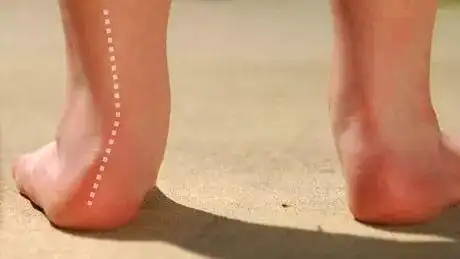 下面是足外翻比较严重的一个图↓足外翻是指孩子在站立或步行时以足