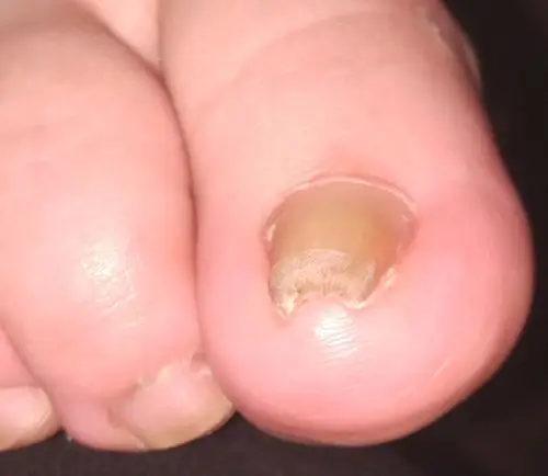 脚趾甲非常厚,而且缩成一团!鼓起来,是什么病