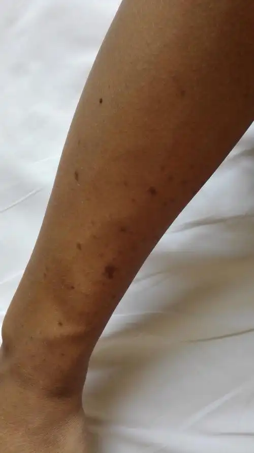 三天前吧 右手臂冒出一些暗的 偏褐色的斑 今天发现左手手背处有一块
