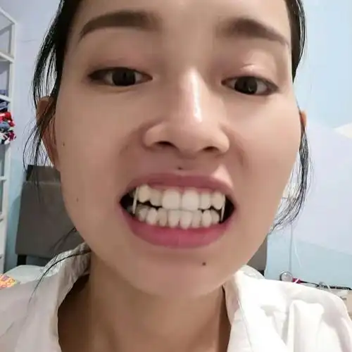 牙齿拥挤矫正 虎牙矫正