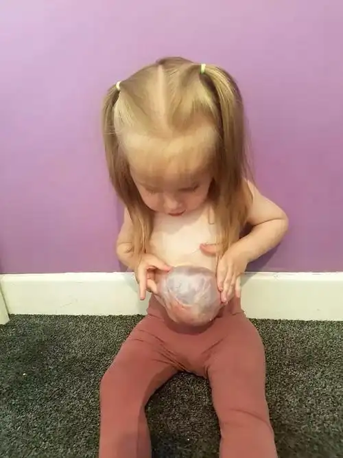 拥有两个肚子的英国小女孩,其母亲曾躺在流产手术台上|怀孕|婴儿|凯莉