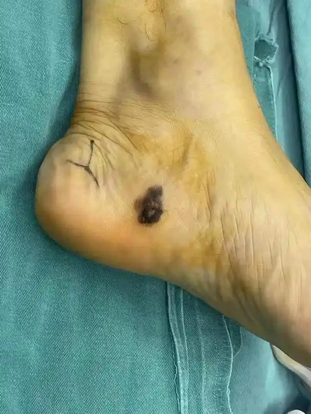 生存率65%,发现即为中晚期的恶性黑色素瘤,可能是身上的小黑痣