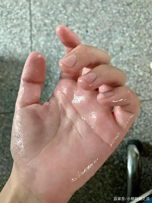 不做水手远离手汗症