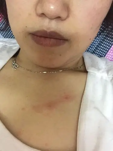 我胸部出了一小片一小片的红点不知道是什么呢?