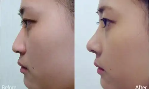 隆鼻对比图