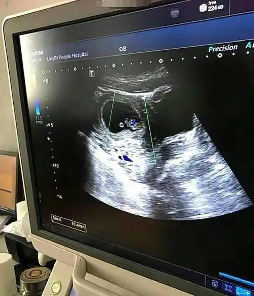 男宝宝可能会隐藏小jj,误认为是女宝检查男宝还是女宝,靠的是医生的