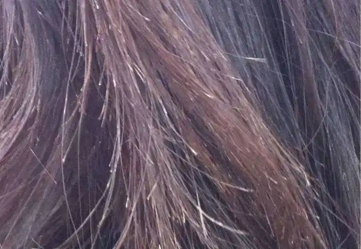 头发为什么分叉头发分叉断发怎么回事