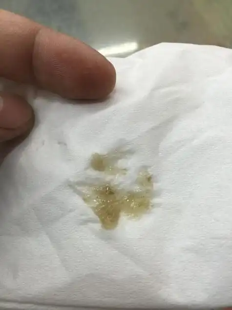 咽喉有痰怎么办?来看看是什么原因导致的