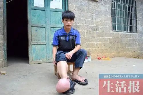 巴马一少年患巨趾症 "大脚男孩"后继无鞋(组图)