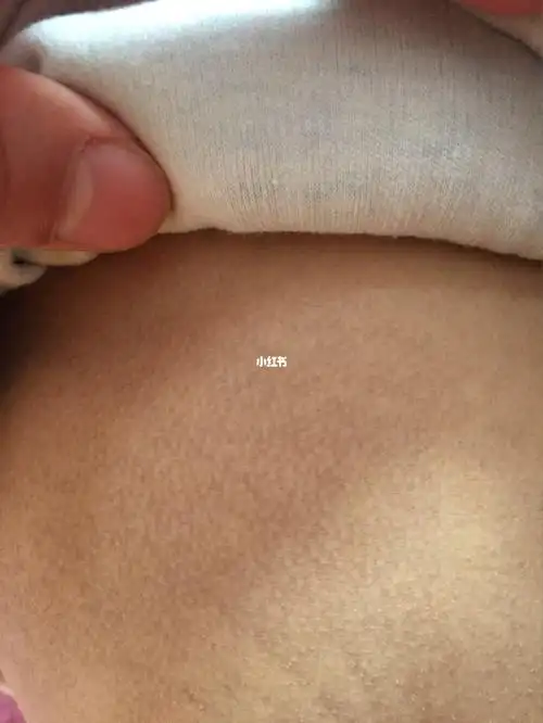 小孩肚子上这段时间突然冒这些花纹斑的东西是怎么回事呢?洗不掉的