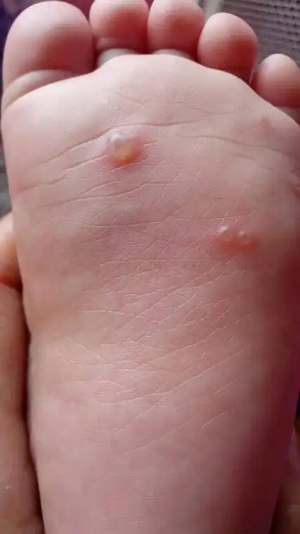 脚上起水泡_泡脚脚上起水泡_水泡脚上有水泡怎么搞