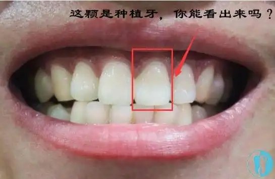 门牙缺失一颗种植后的效果
