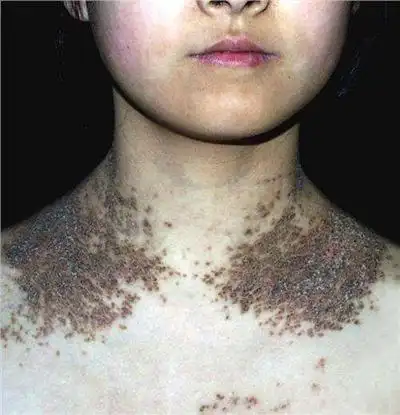 毛周角化症图片39