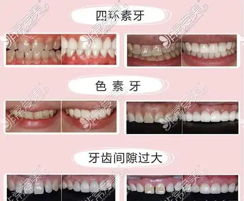 贵阳做牙齿贴片多少钱一颗?氟斑牙四环素牙贴面价格公开!