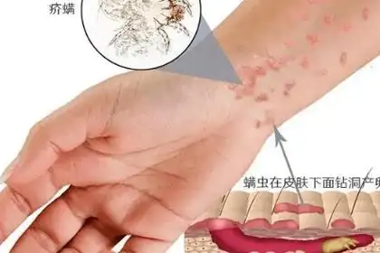 疥疮是由疥螨在人体皮肤表皮层内引起的接触性传染性皮肤病.