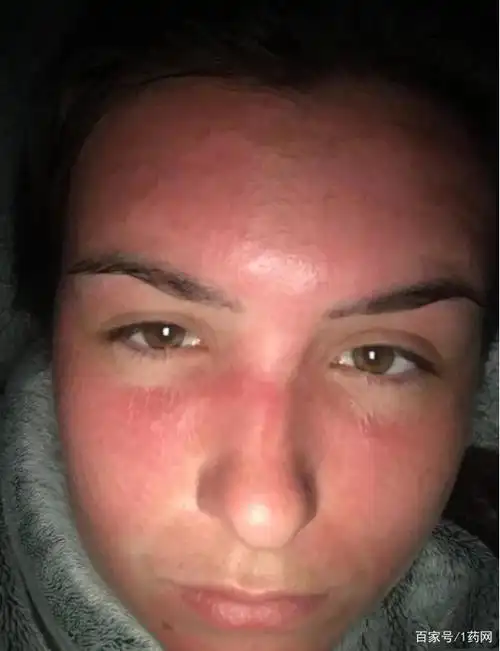 太阳中毒?英国女子在海滩晒6小时,整张脸肿起来