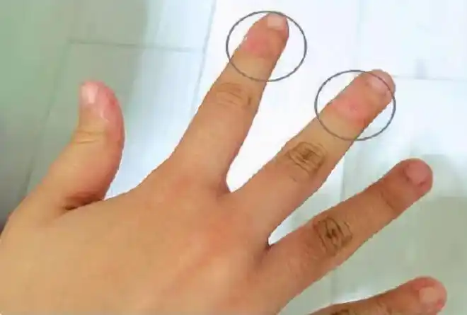 警惕!12岁女孩爱啃手指至变形,孩子到了这年龄还吃手容易毁颜值