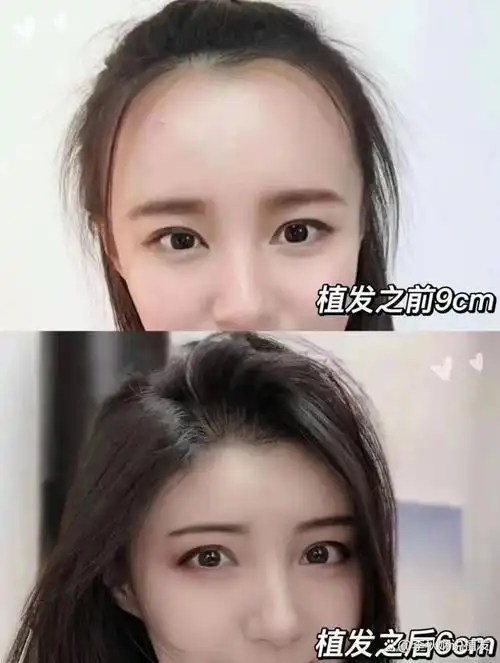 日渐变高的前额发际线,已经严重影响到李女士的交际和工作,多方面对比