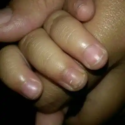 现在手指甲有点鼓起.有没有事啊