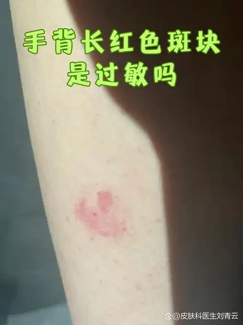 手背长红色斑块是过敏吗