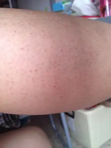 你好我的小腿上有许多小红疹是因为湿热