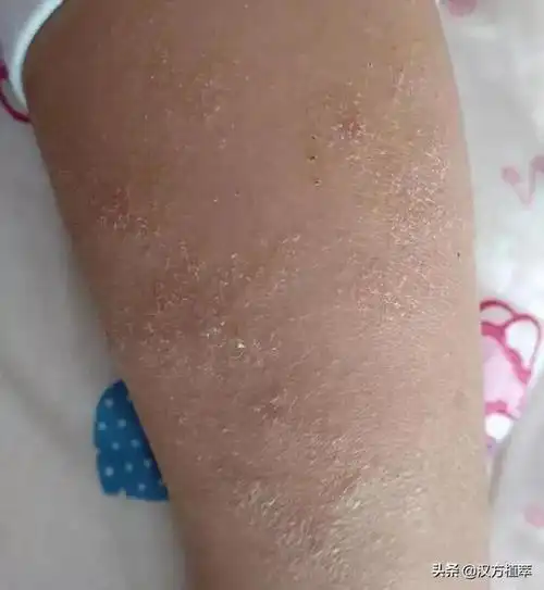 湿疹病情判断(湿疹还有干性的)(3)