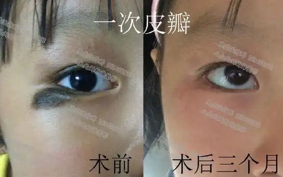 下眼睑黑痣皮瓣手术效果