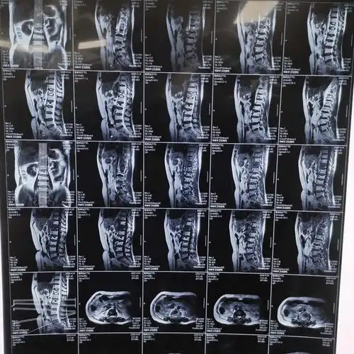 术前mri示:胸12椎体压缩性骨折