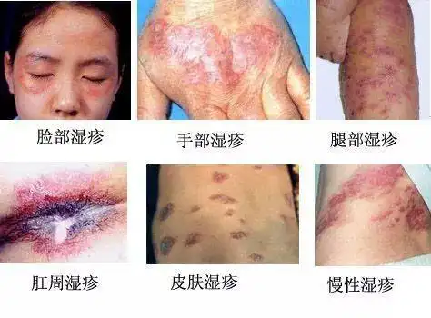 肛门周围瘙痒难耐怎么会突然患上了肛周湿疹会不会传染