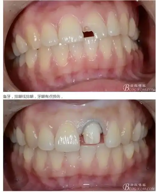 【原创博客】一例前牙氧化锆全瓷单冠——王坤