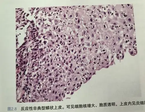 宫颈鳞状上皮病变