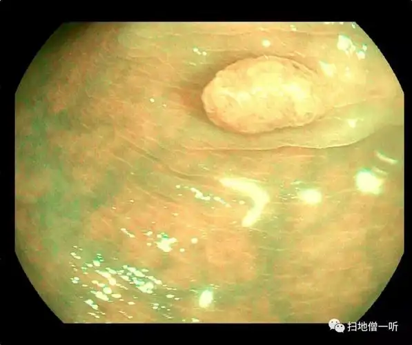 如何在肠镜检查中减少漏诊