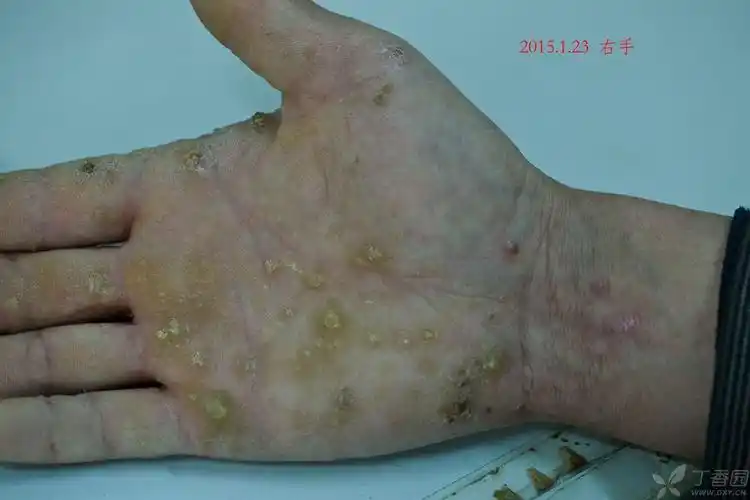 【病例讨论】这个病例该怎样处理有什么好方法 [病例帖]